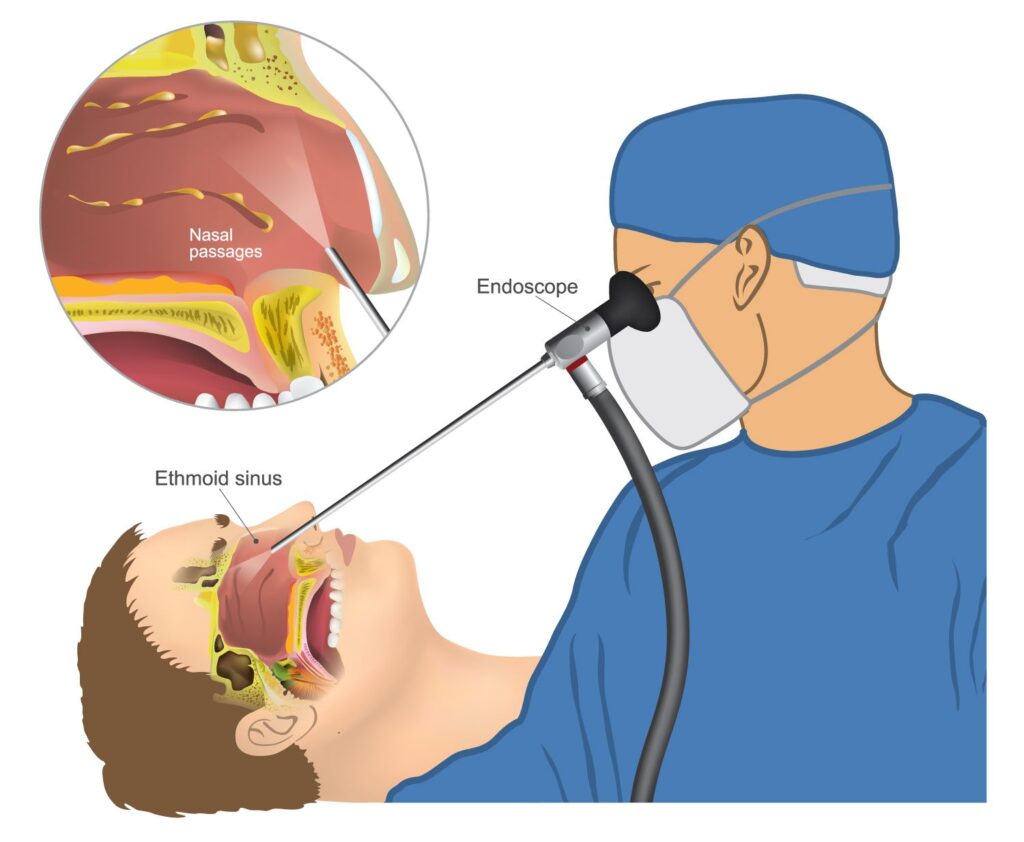 آندوسکوپی سینوس و بینی و جراحی بینی